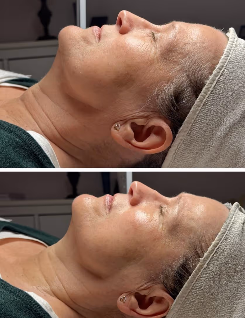 Jeuderm Angel Peel Enne ja pärast