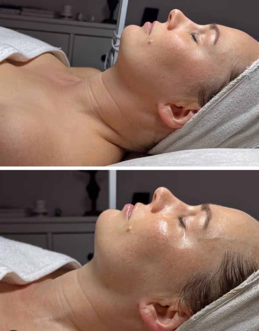 Jeuderm Angel Peel Enne ja pärast