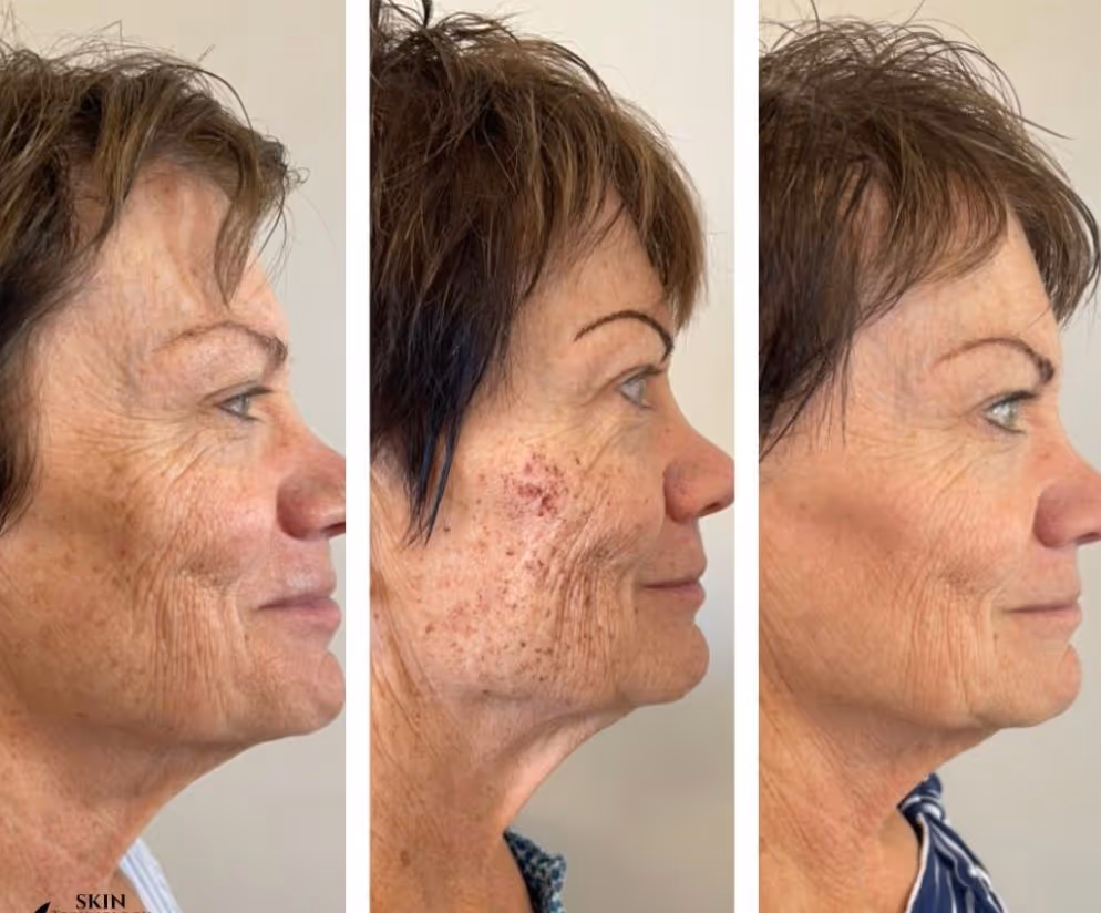 SOLRAY IPL - näide 3