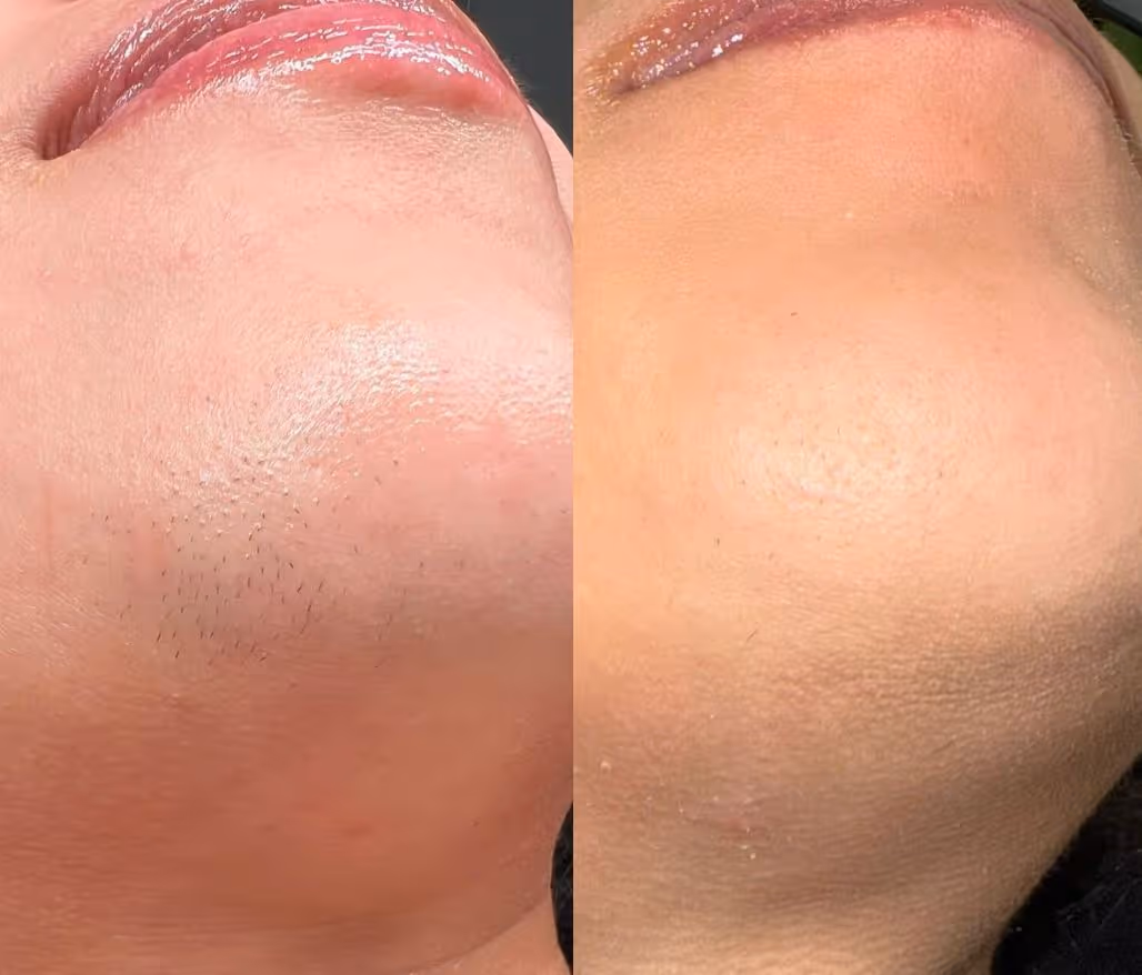 SOLRAY IPL - näide 4