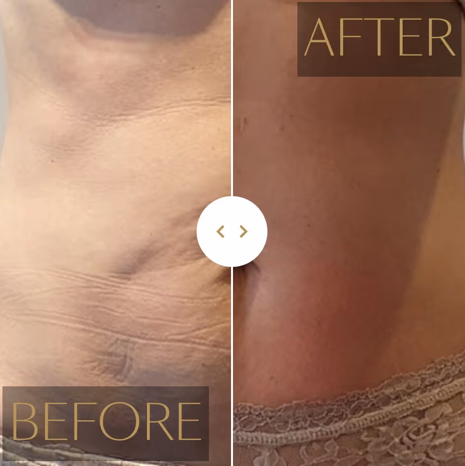 Kuidas Cellution® toimib?