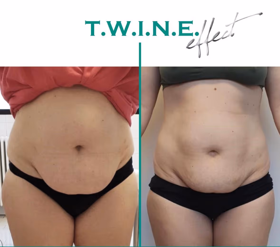 Tulemus Pärast 3 protseduuri