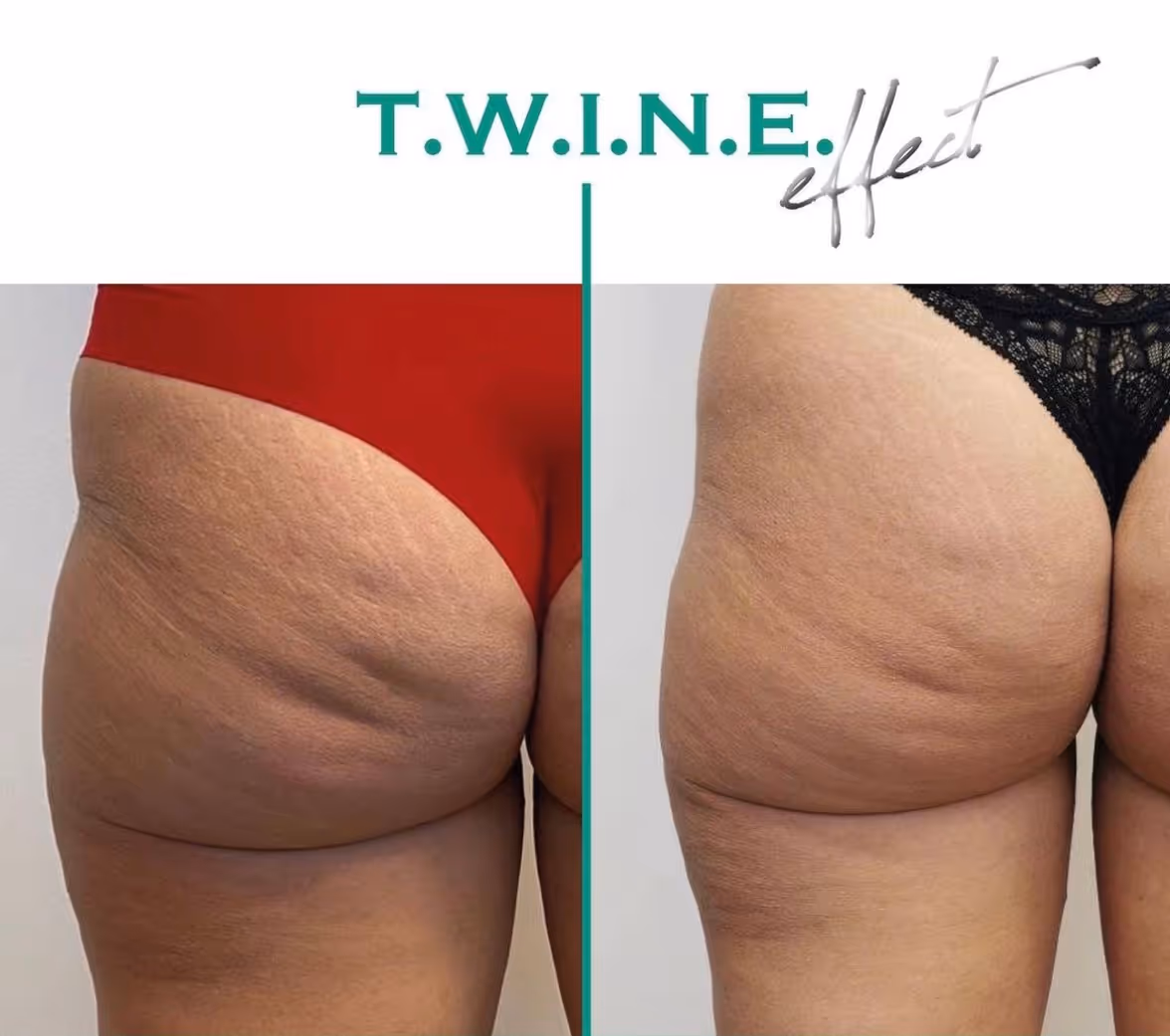 Tulemus Pärast 1 protseduuri