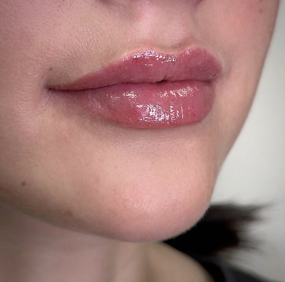 Miks eelistada huulte täitesüstimist?