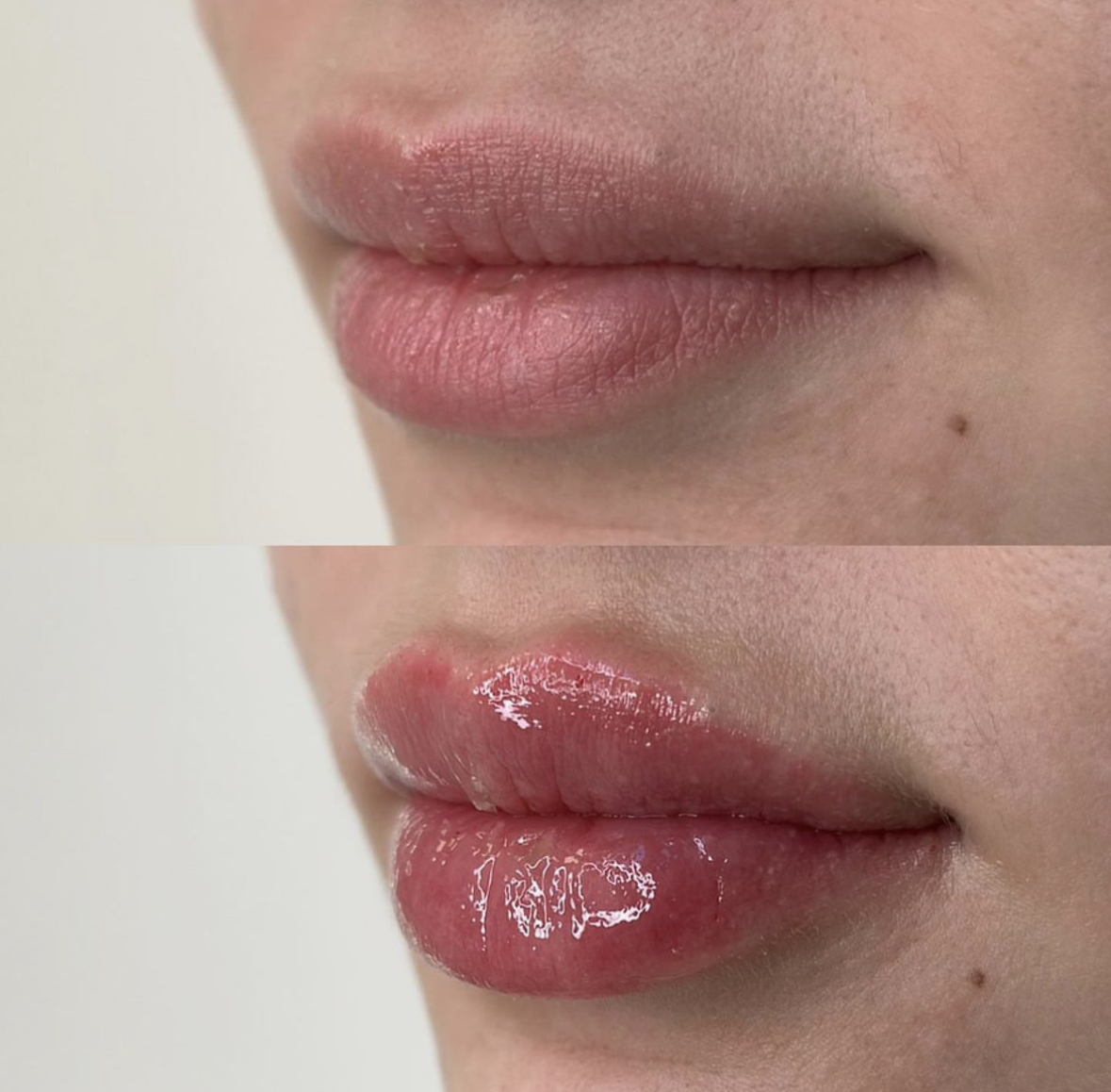 Vaata kasvõi seda näidet, kus Julia Skudra muutis veatud huuled veelgi kaunimaks