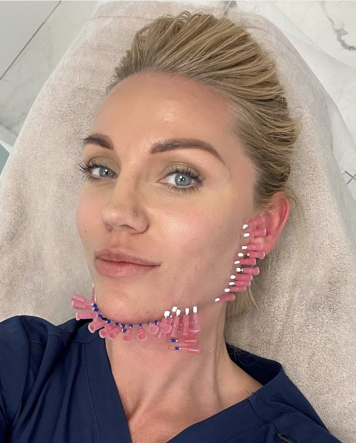 Miks näo- ja mesoniite eelistada?